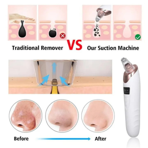 5 in 1 Rechargeable Blackhead Remover | Electric Pore Vacuum & Acne Extractor