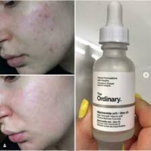 The Ordinary Niacinamide 10% + Zinc 1% – Blemish Control & Brightening Serum (30ml)
