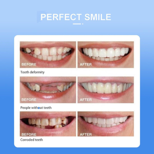 Snap On Smile – Instant Perfect Teeth Veneers (No Dentist Required)